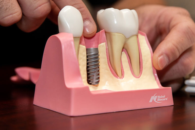 dental-implant-model-3_1-768x513.jpeg