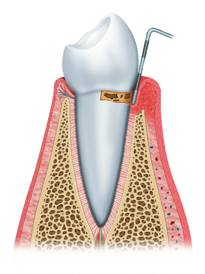 gum disease graphic stage 1