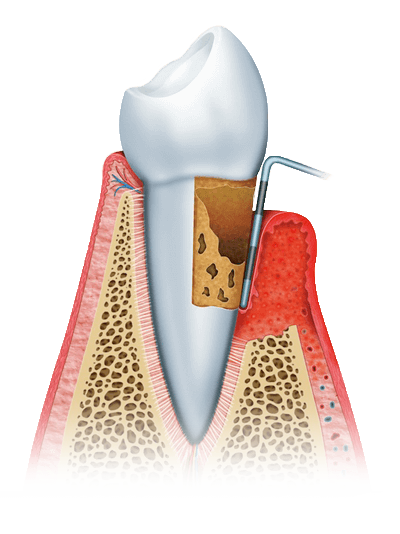 gum disease graphic stage 3