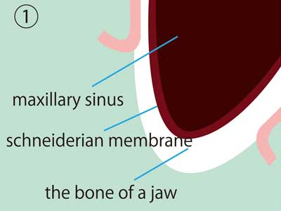 PDM Sinus Lift Step 1