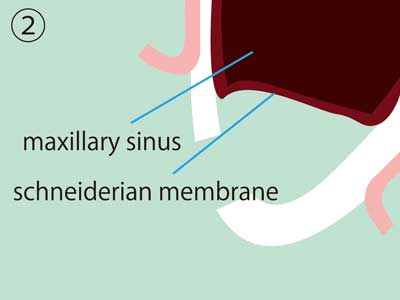 PDM Sinus Lift Step 2