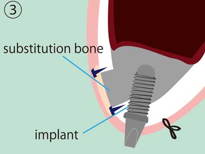 PDM Sinus Lift Step 3