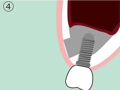 PDM Sinus Lift Step 4