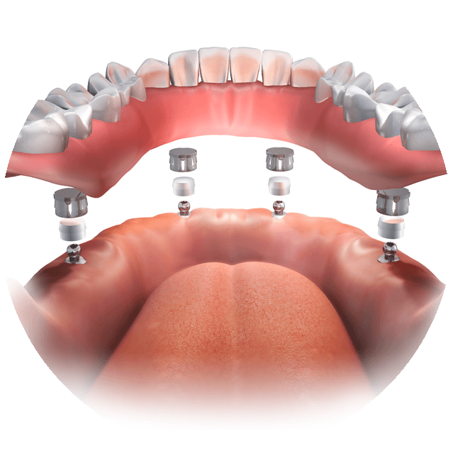 ball retained dentures graphic