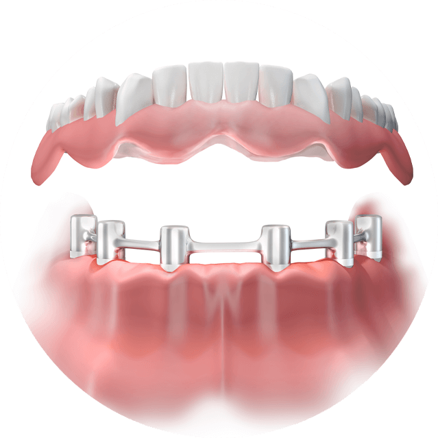 bar retained dentures graphic