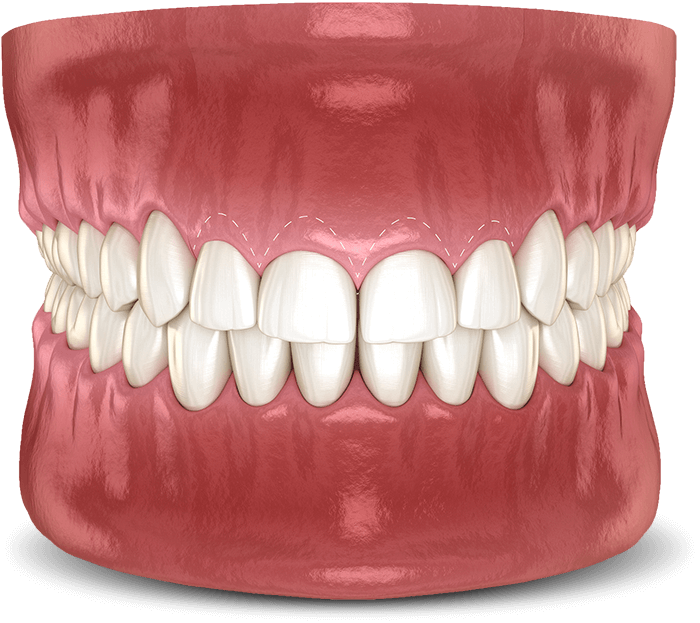 crown lengthening graphic