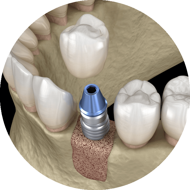 dental bone graft graphic