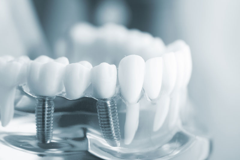 dental implants model