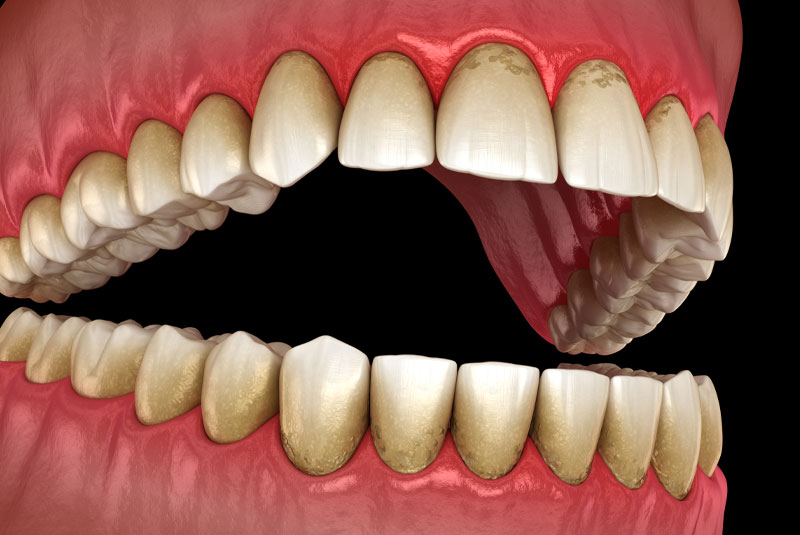 gum disease graphic