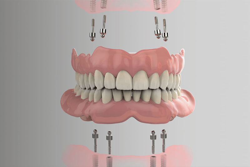 implant supported dentures model