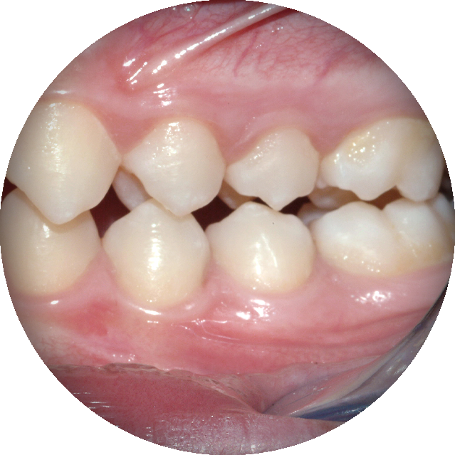 malocclusion