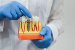 dentist holding a dental implant model bone cutaway