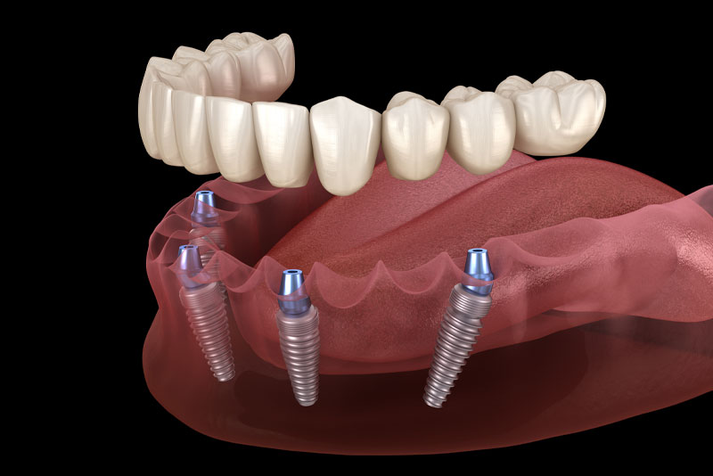 a full mouth dental implant model with four implants