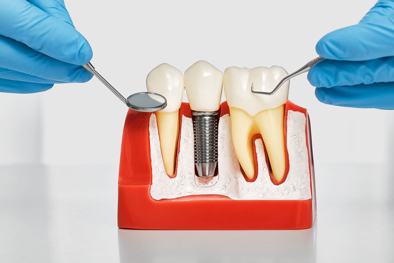 dental implant model bone cutaway showing a single post dental implant