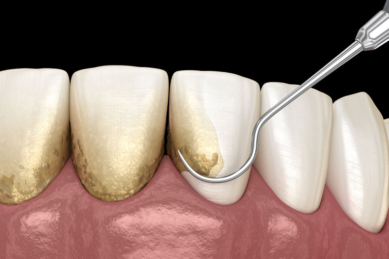image of a dental model showing teeth and gums undergoing scaling and root planning