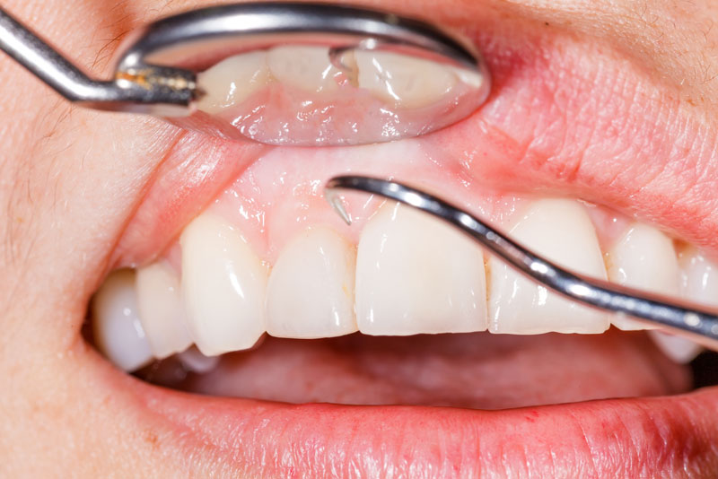 a dental patient having her gums and loose teeth examined because she has gum disease