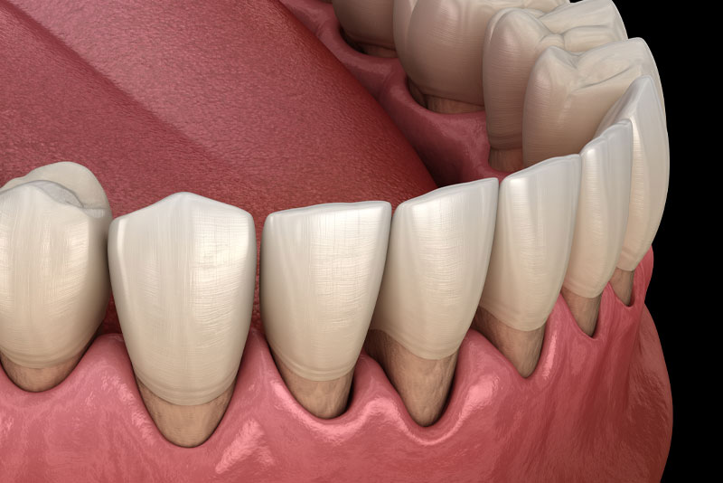 a graphic depicting gums affected by gum recession