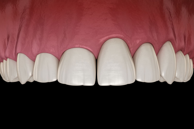 a graphic depicting gums in need of a gingivectomy