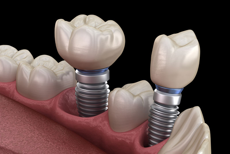 a model of two placed dental implants