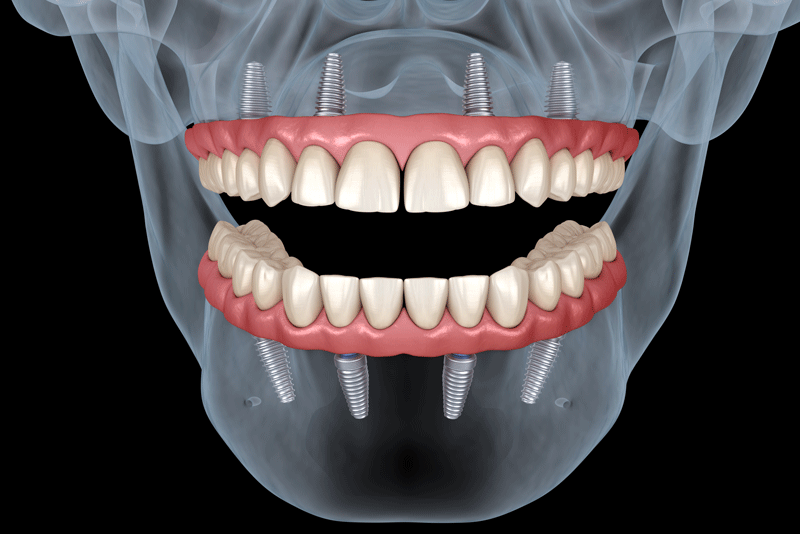 an image of a skull x-ray showing the All-On-4 dental implant's, in color, in the mouth.
