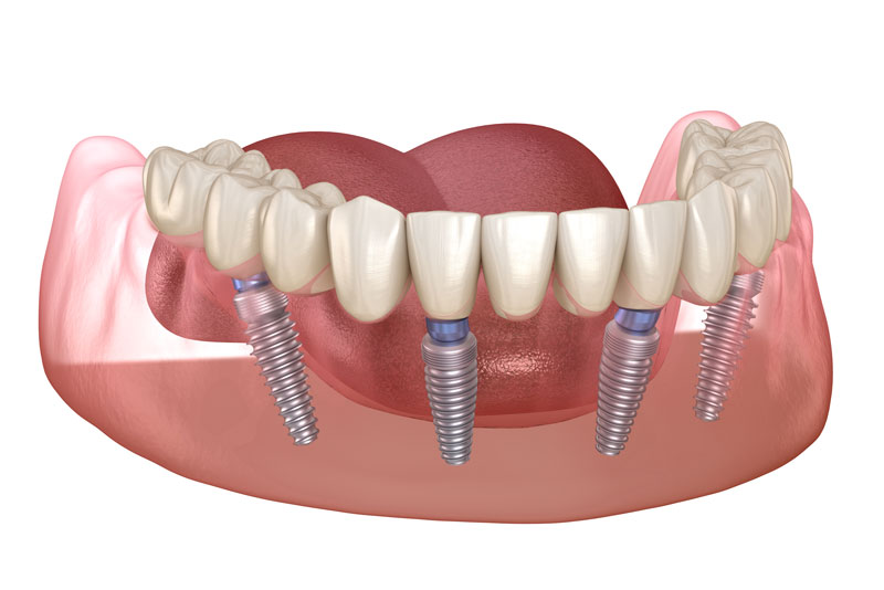 an All-On-4 dental implant model that has four dental implants placed in the gums to support the dental prosthetic hovering over the implants.