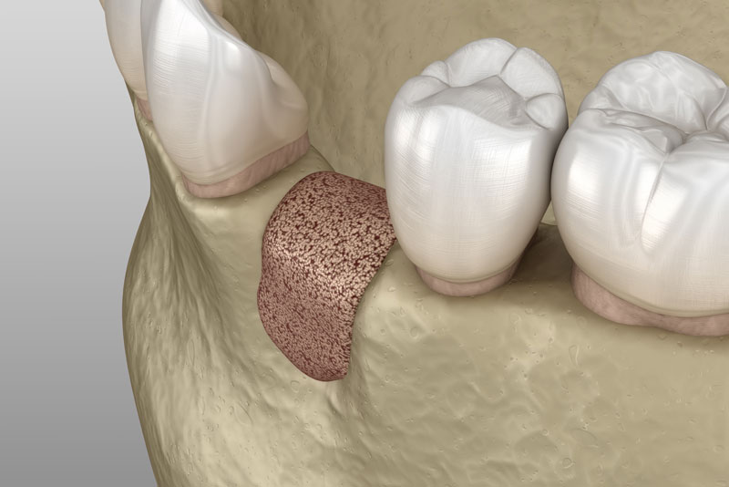 Missing Tooth Bone Grafted Between 2 Healthy Teeth