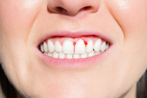 a picture of a patient who is showing her smile that is going to get treated with periodontal maintenance.