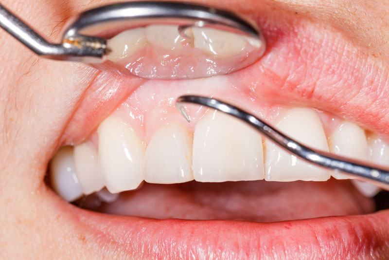 dental-patient-with-gum-disease.