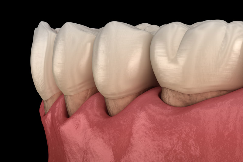 a graphic image of a lower arch of teeth that has gum recession and needs to be treated with a gum grafting procedure.