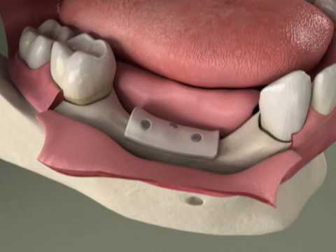 3D model of a bone-graft example.