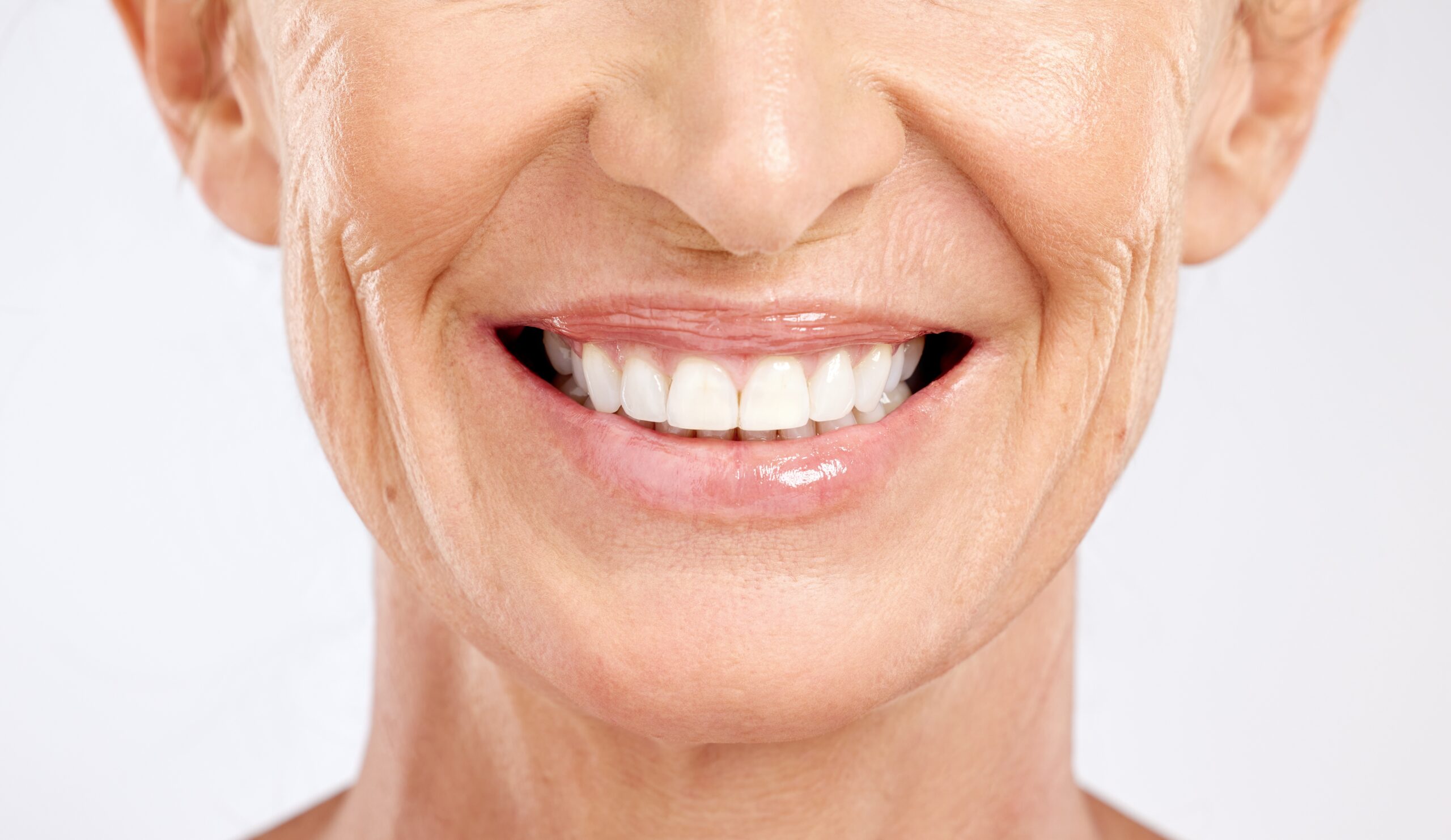 An image of a woman smiling after a gum grafting procedure.