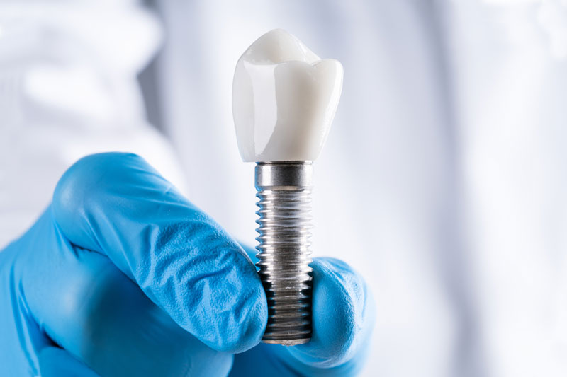 a periodontist holding up a single dental implant in order to explain how it will be a cost-effective tooth replacement option.