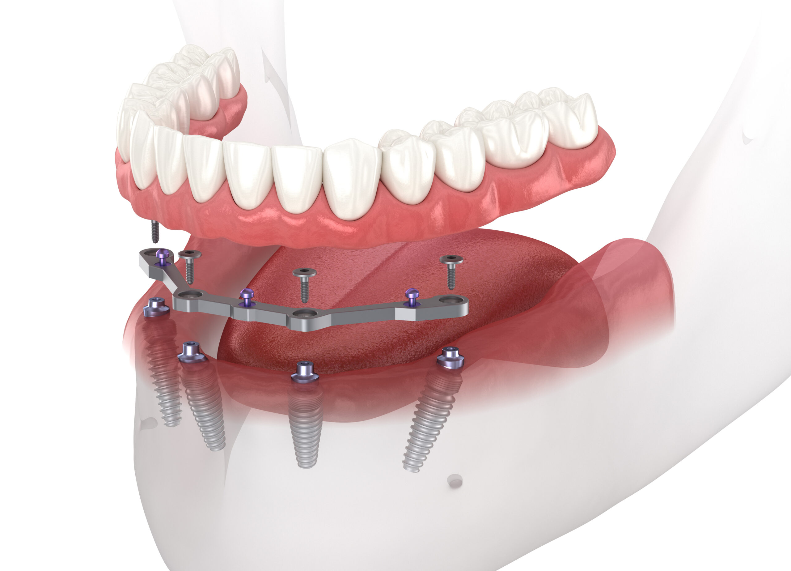 a 3D image of all-on-four dental implant.