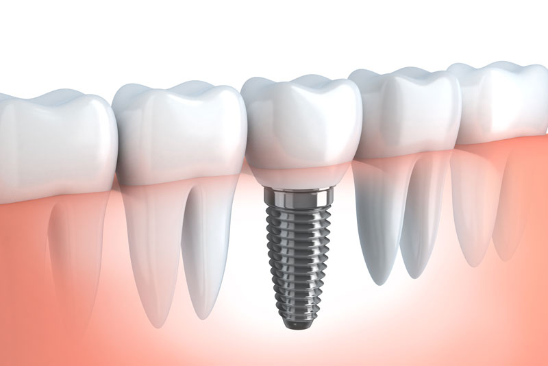 dental-implant-in-gumline.