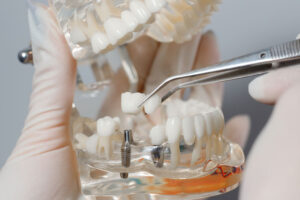 Photo of a doctor holding and working on a clear jaw prosthesis with an implant in it