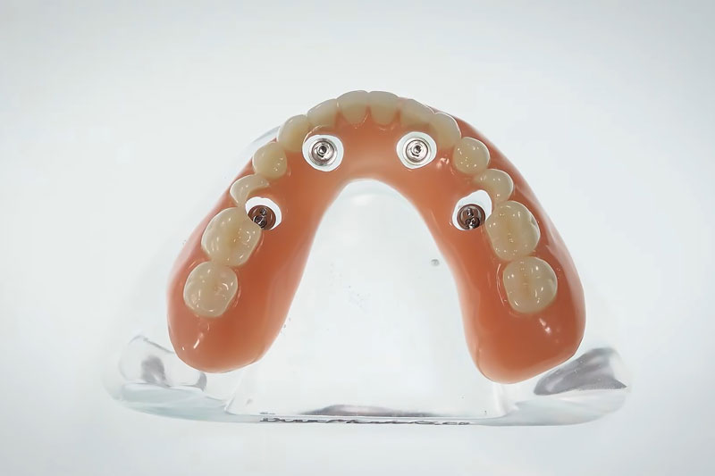 a full arch of teeth with 4 implant holes to attach the arch