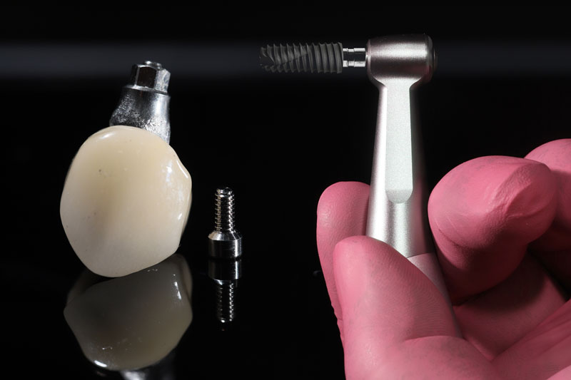 a single dental implant with a dentist holding up a tool for placement