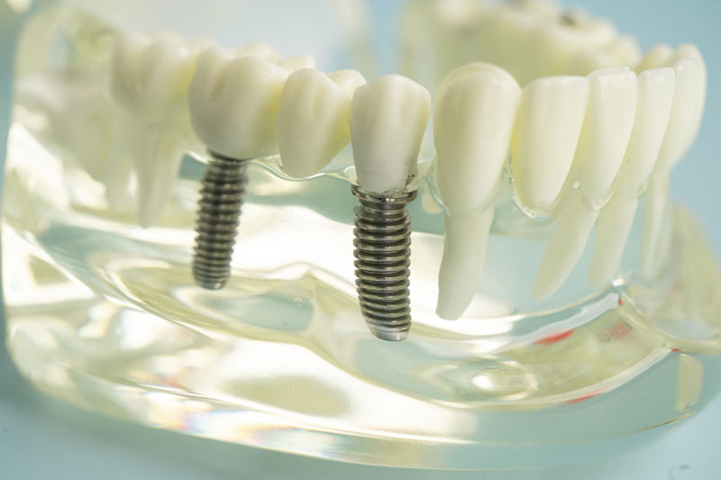 2 single dental implants with a crown on top and a clear jaw model
