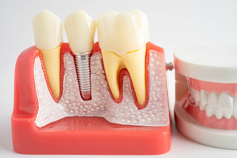 a single dental implant next to a full arch of teeth model