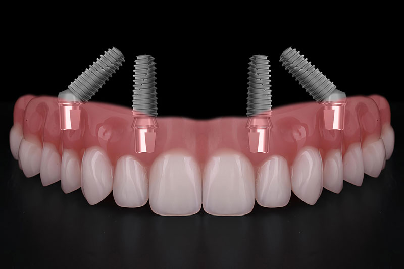 a full arch of all on 4 dental implants being shown