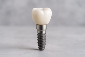dental implant being shown with a crown on top of it