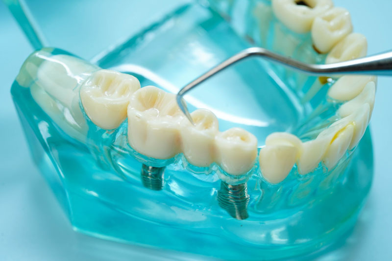 2 single dental implants with a dentist holding a tool