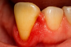 Close up of a receding gum line on a patient. The tooth is yellowed and the gums are inflamed. No text on image.